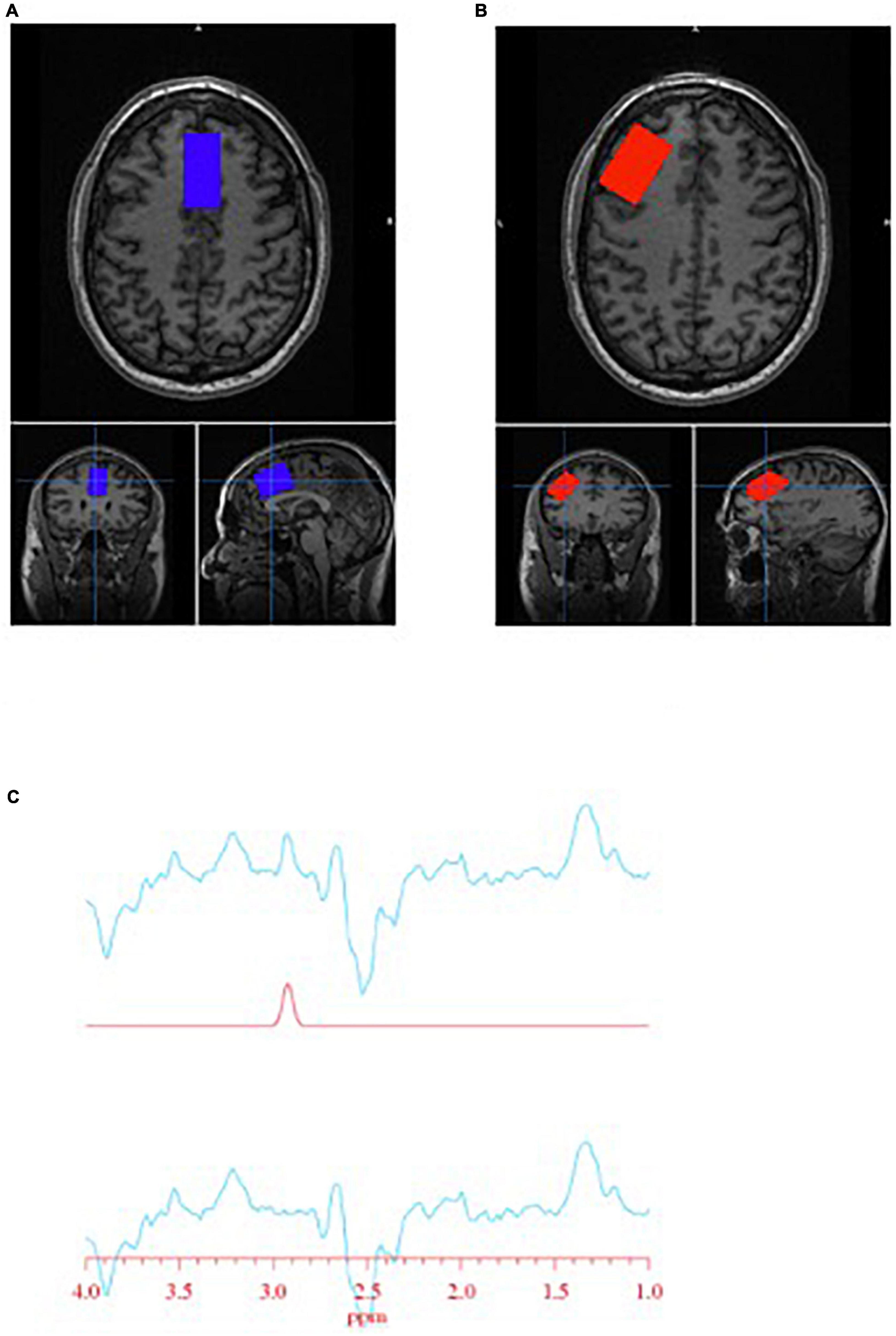 Imaging oxidative stress in brains of chronic methamphetamine users: A combined 1H-magnetic resonance spectroscopy and peripheral blood biomarker study